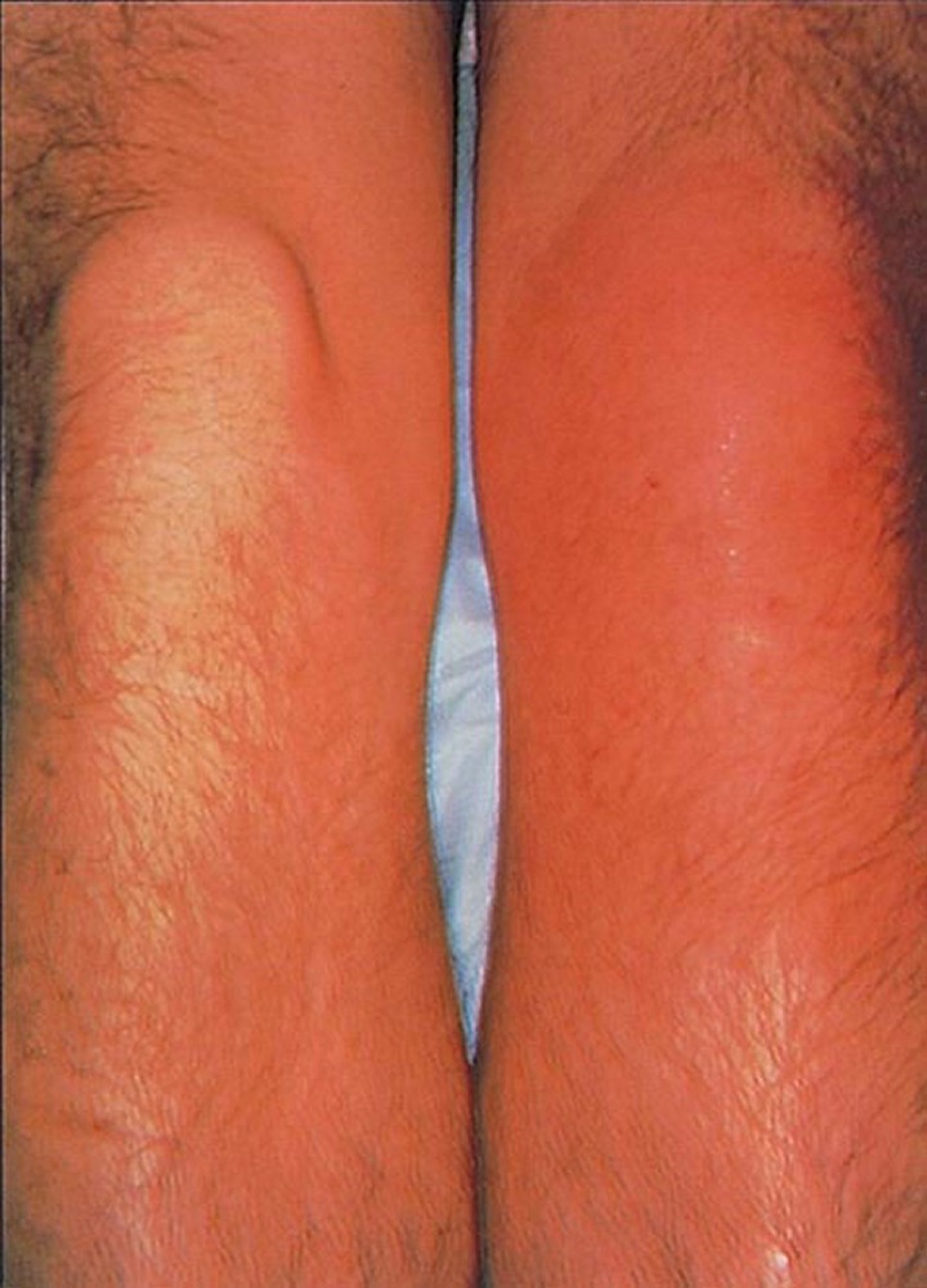 Prepatellar Bursitis