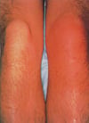 Bursite prépatellaire