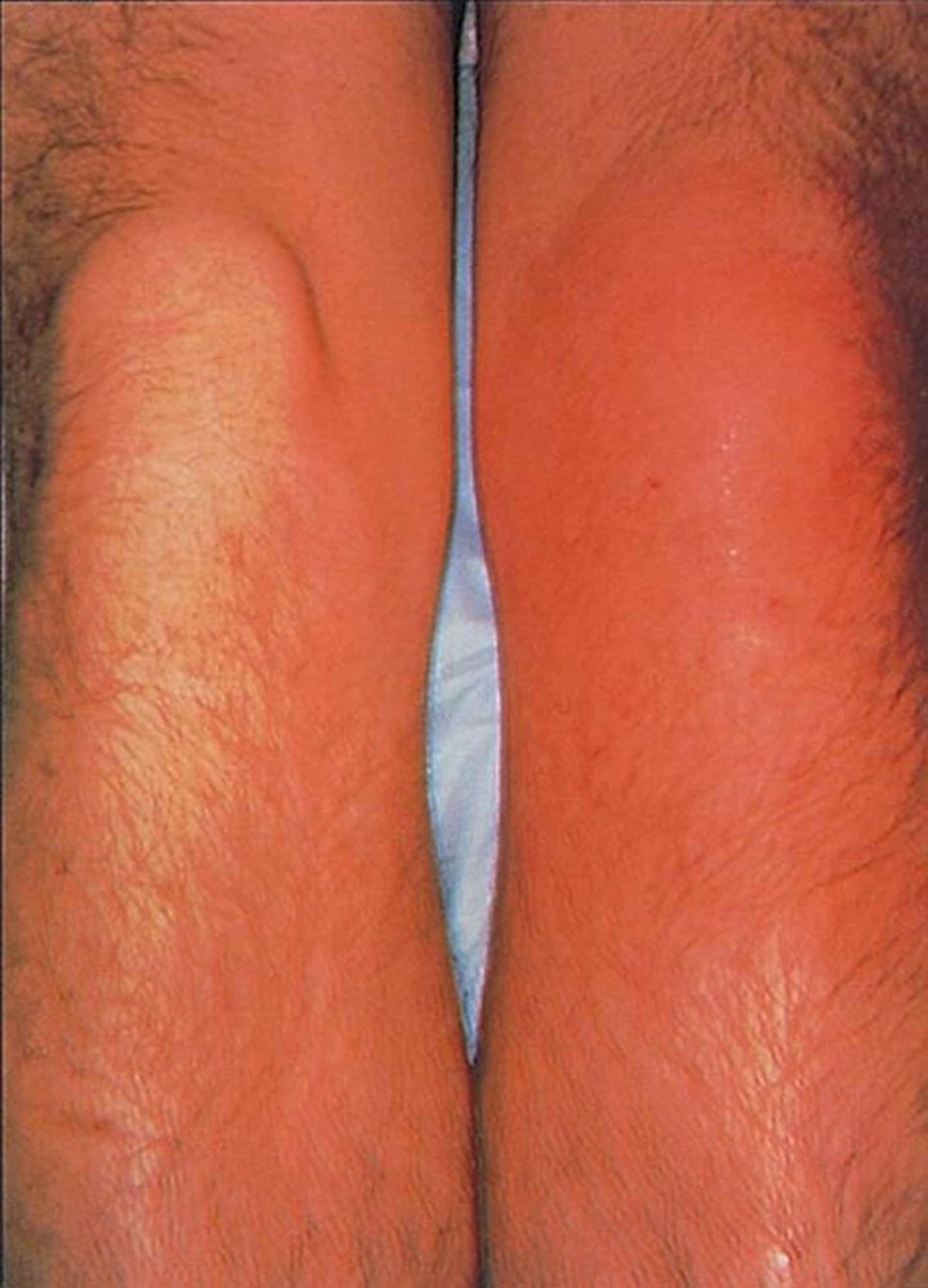 Bursite prépatellaire