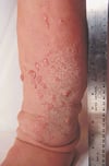 バセドウ病患者の脛骨前粘液水腫