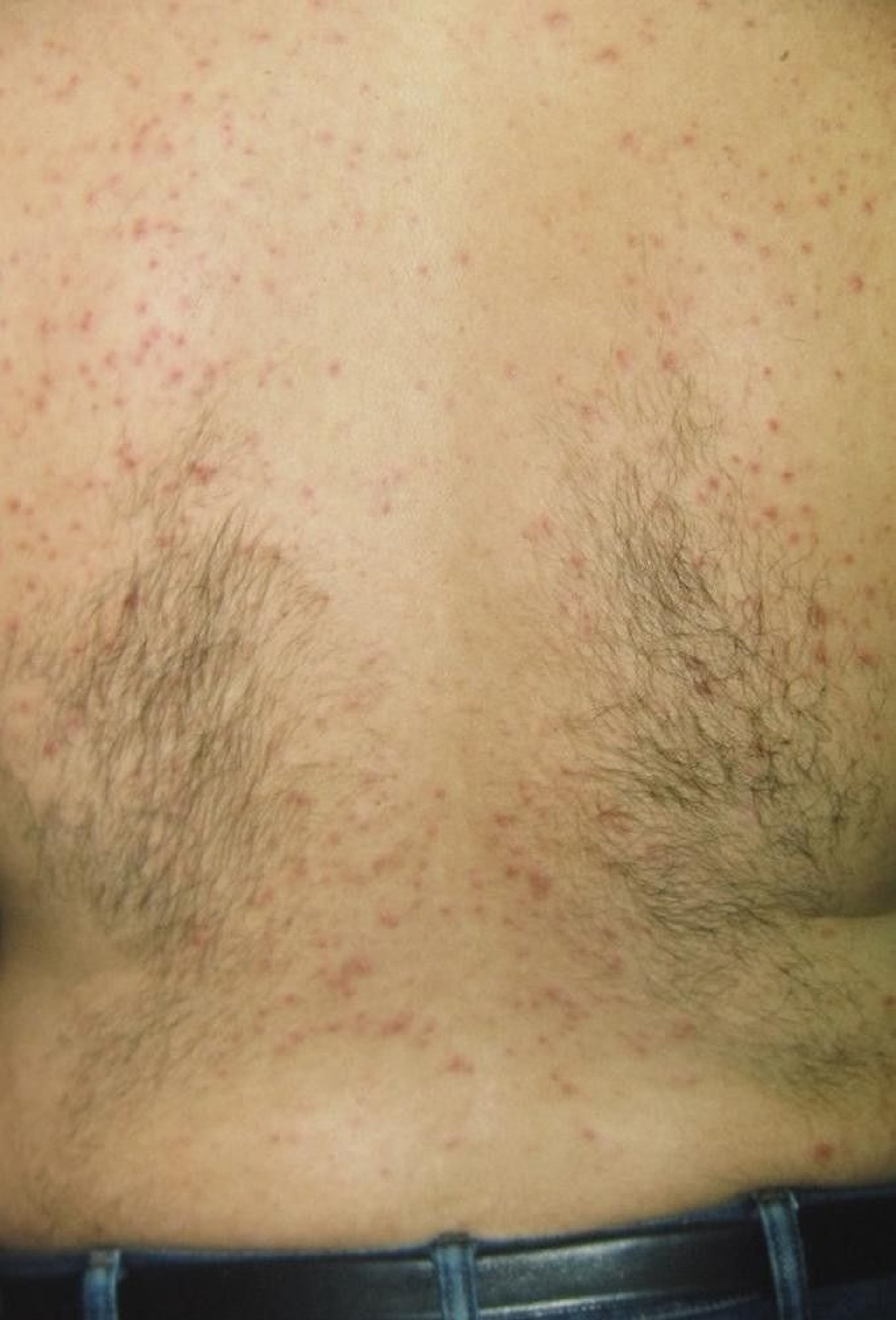Miliaria Rubra (Prickly Heat)