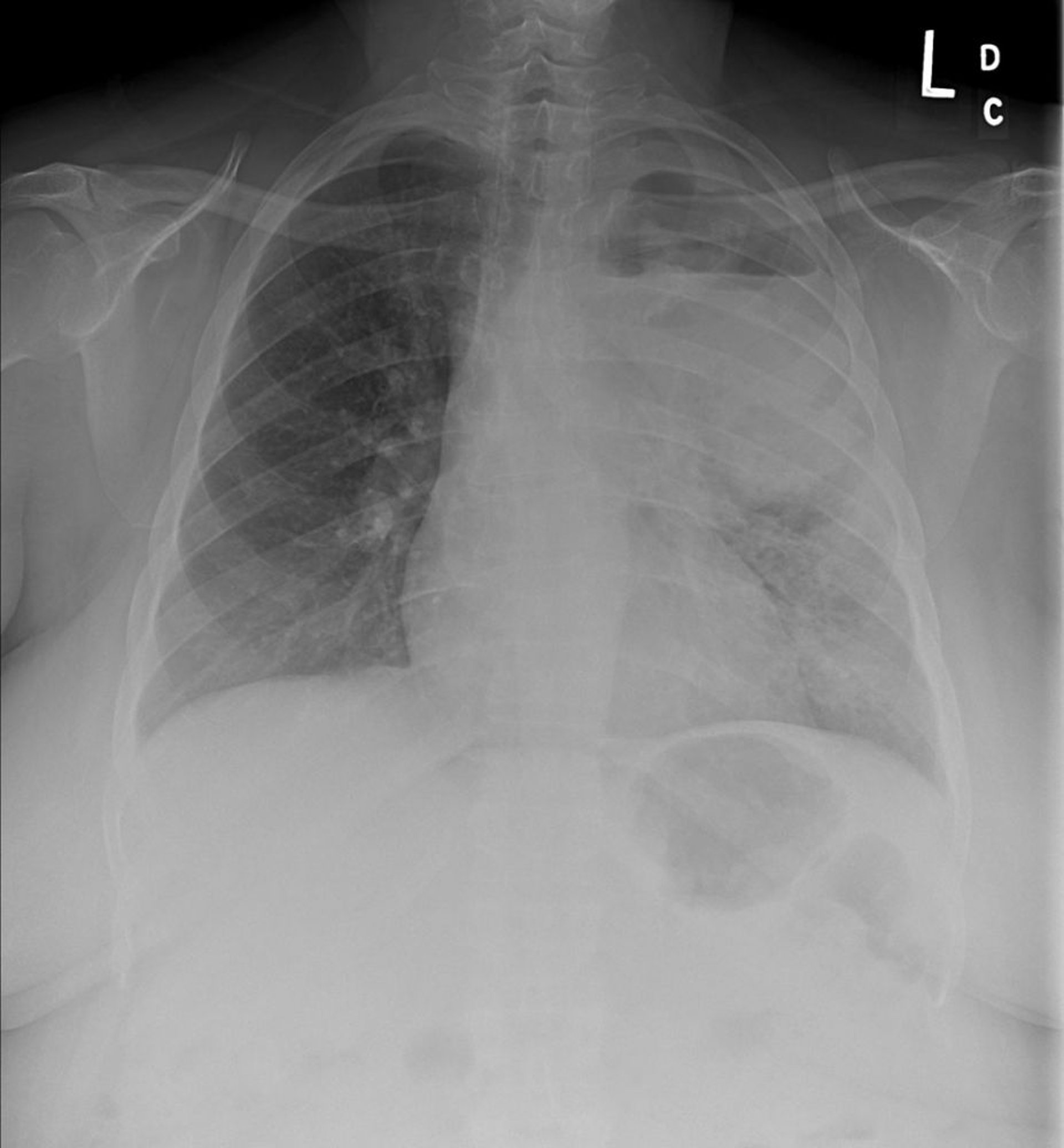 Câncer pulmonar primário