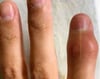 Tumefacción de una articulación interfalángica distal