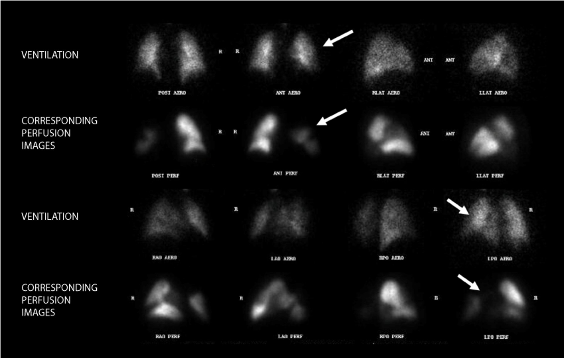 Pulmonary Embolism (Ventilation-Perfusion Scan)