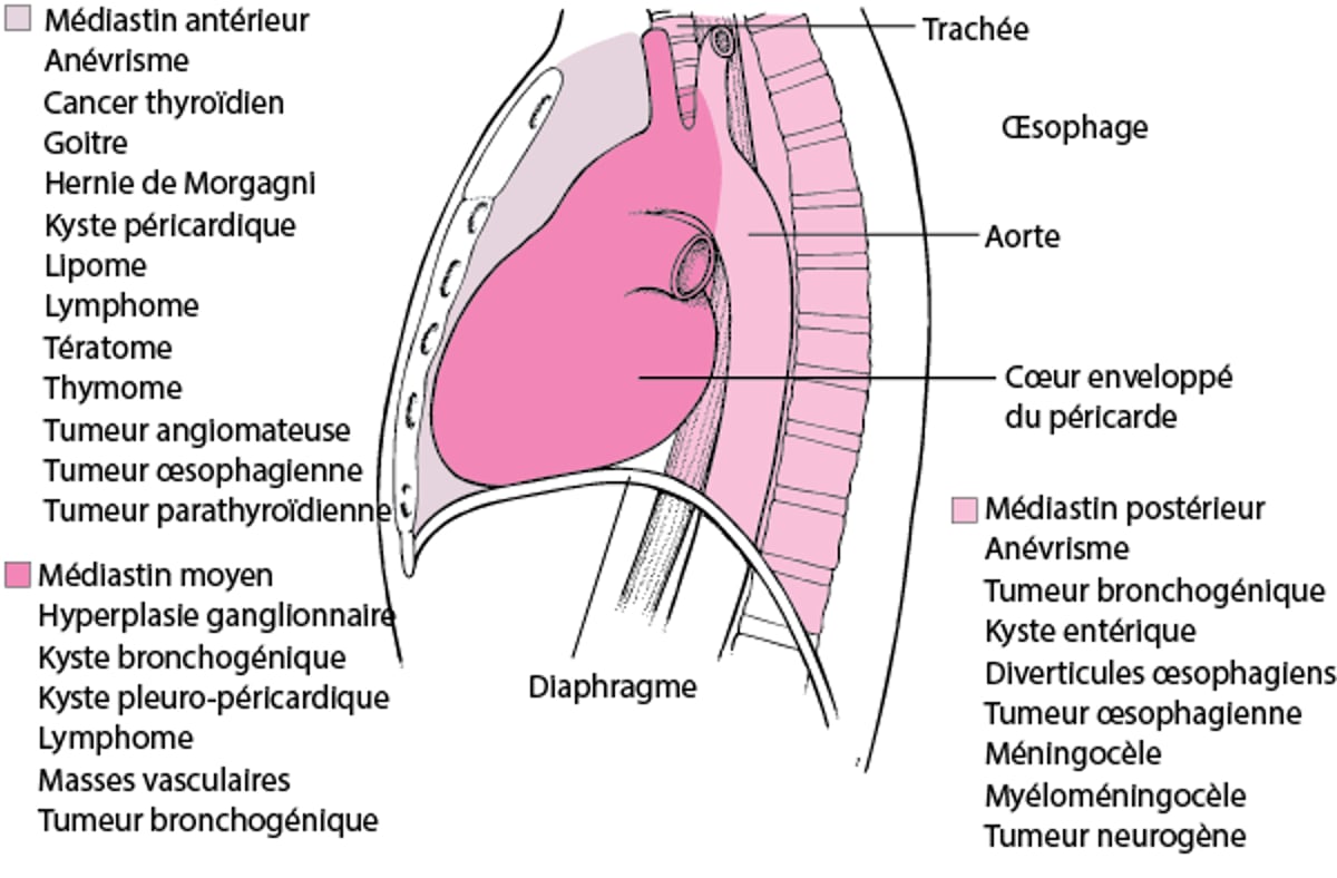 Certaines causes de masses médiastinales chez l'adulte