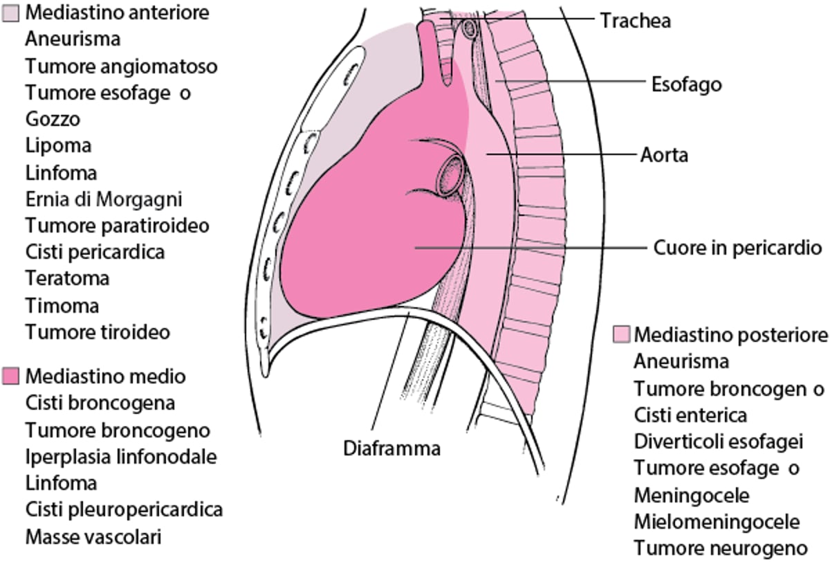 Alcune cause di masse mediastiniche negli adulti