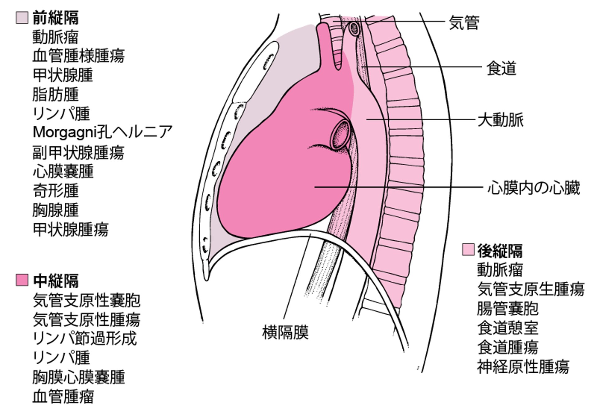 成人における縦隔腫瘤の主な原因