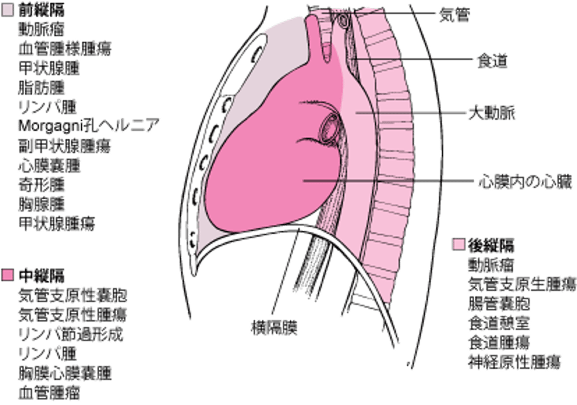 成人における縦隔腫瘤の主な原因