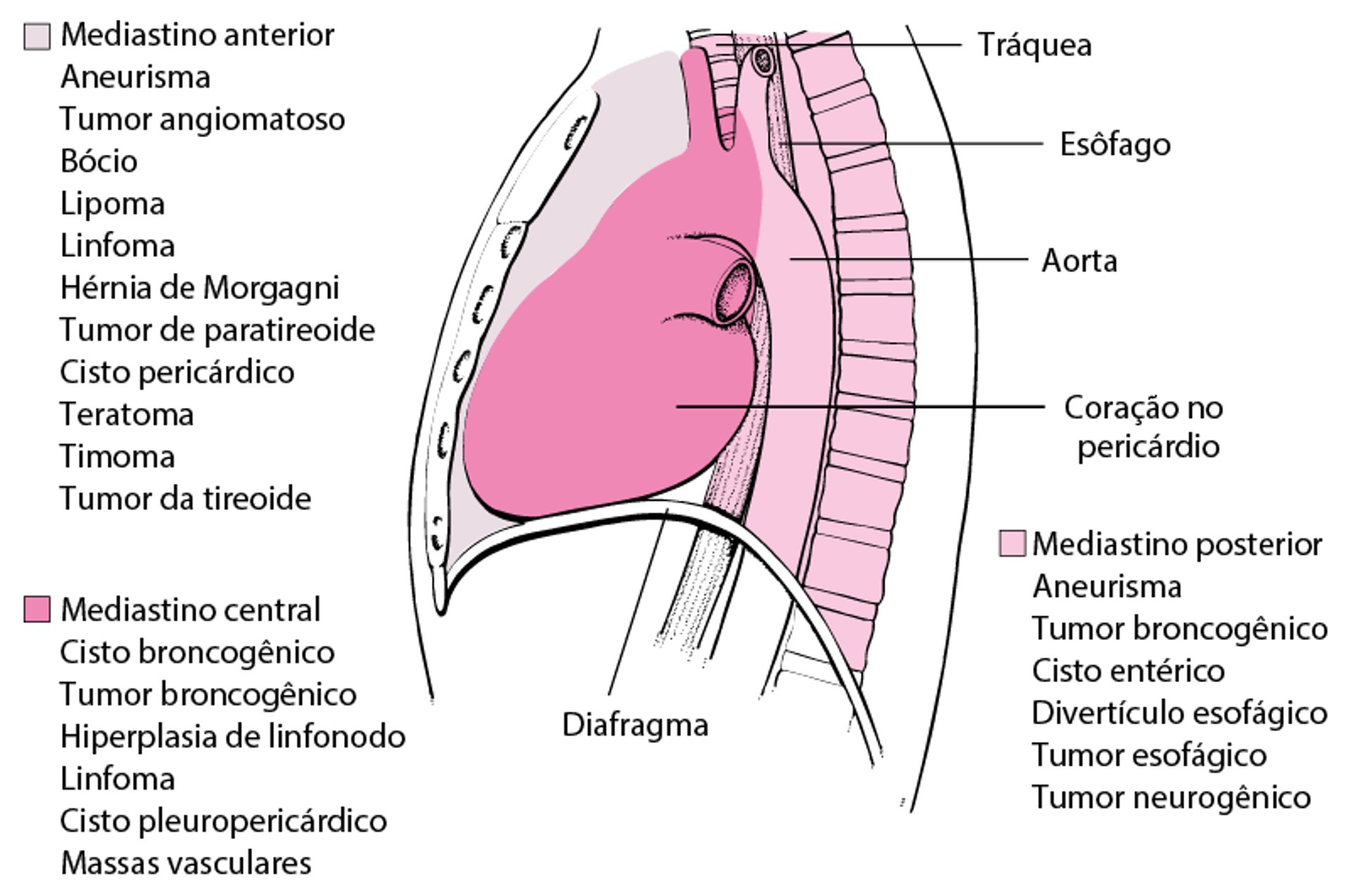 Algumas causas de massas mediastinais em adultos