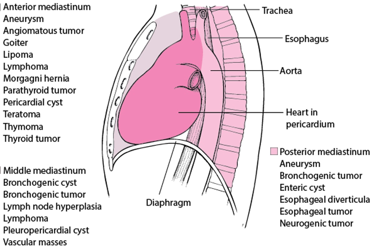 Деякі причини об’ємних утворів середостіння в дорослих