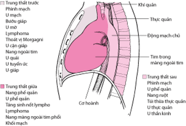 Một số nguyên nhân gây khối trung thất ở người lớn