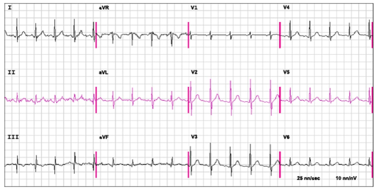 An ECG in Pulmonary Embolism