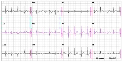 An ECG in Pulmonary Embolism