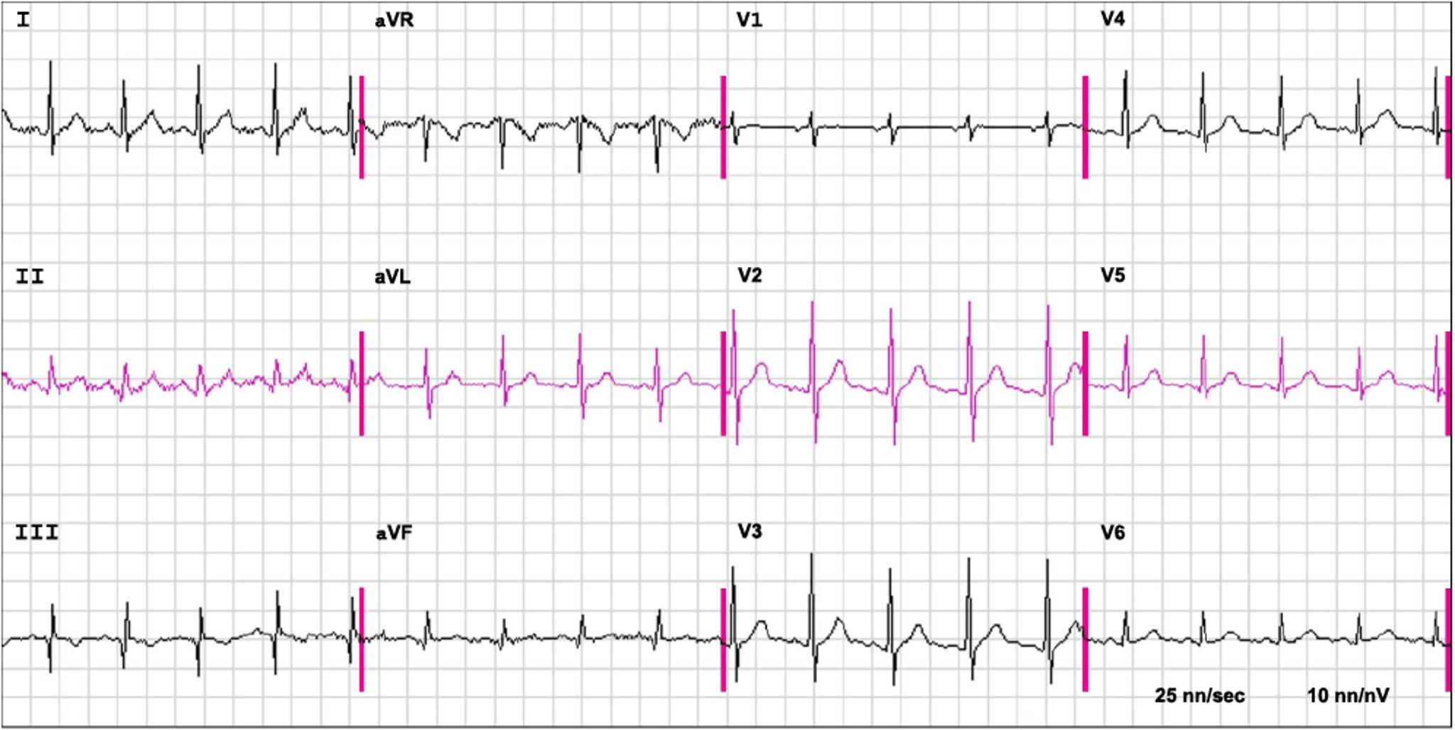 Ein EKG bei Lungenembolie