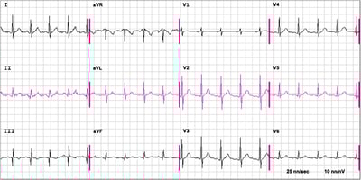 Ein EKG bei Lungenembolie