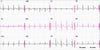Un ECG en la embolia pulmonar