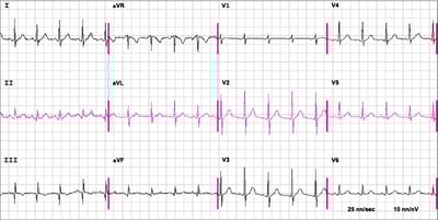 Un ECG dans l'embolie pulmonaire