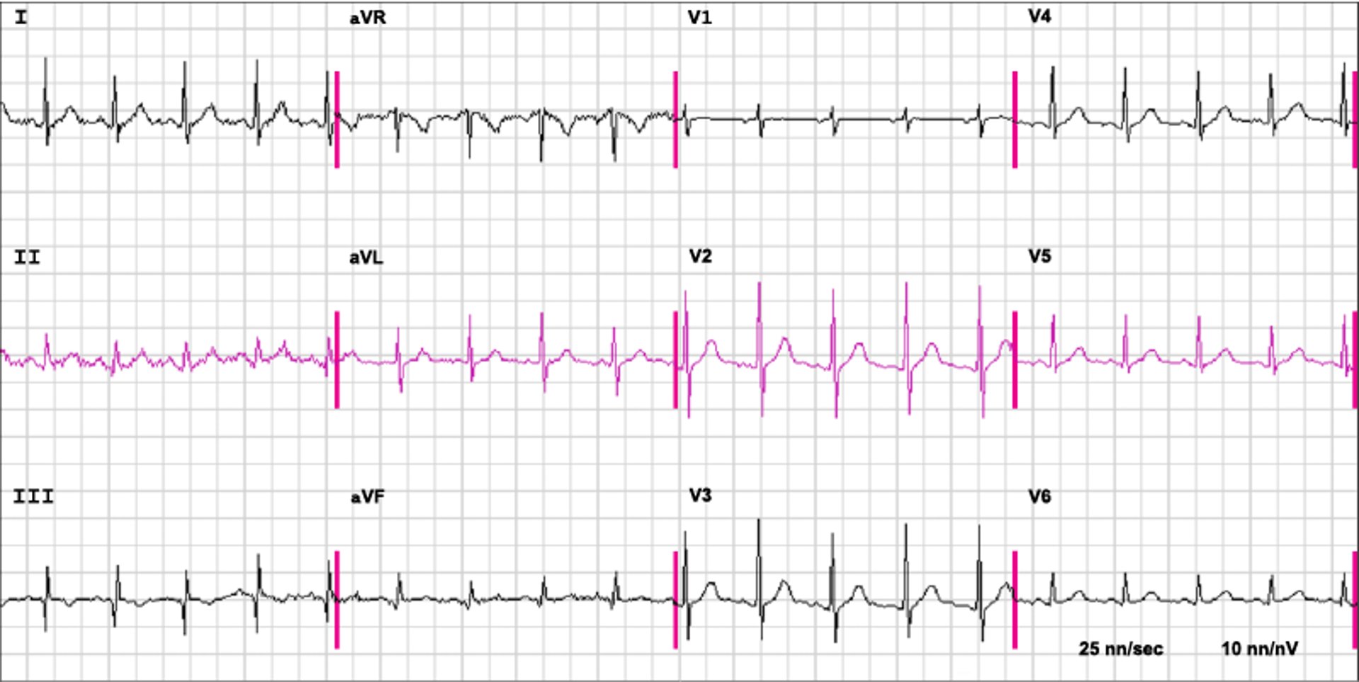 Un ECG nell'embolia polmonare