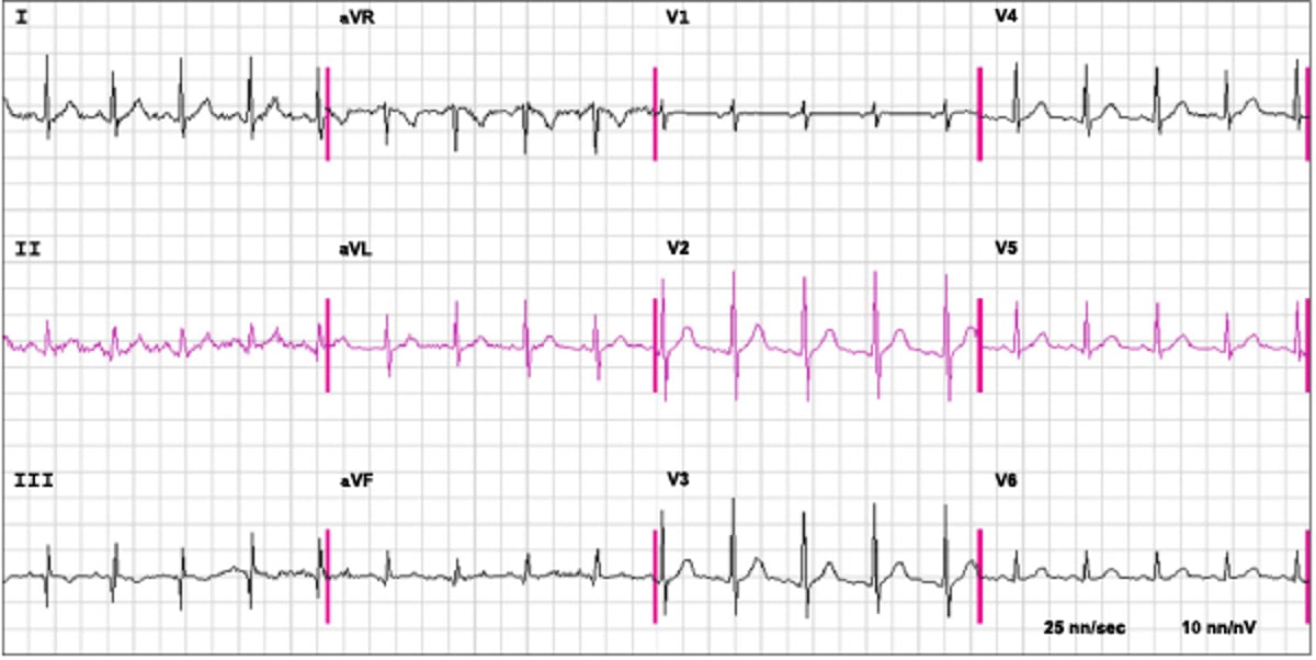 Eletrocardiograma (ECG) na embolia pulmonar