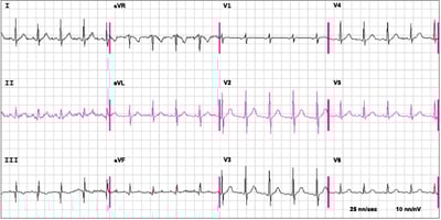 Eletrocardiograma (ECG) na embolia pulmonar