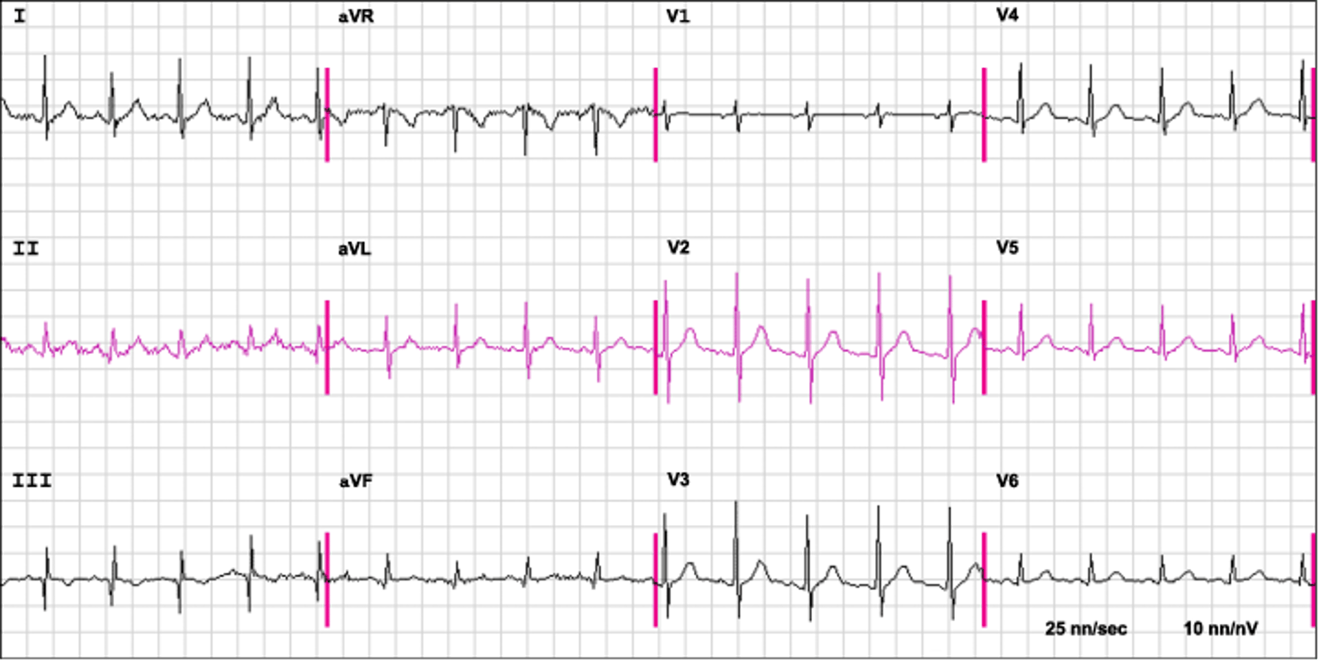ЭКГ при ТЭЛА