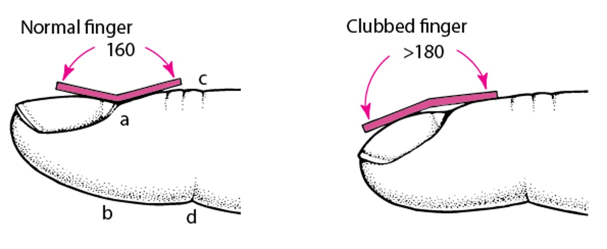 Measuring Finger Clubbing