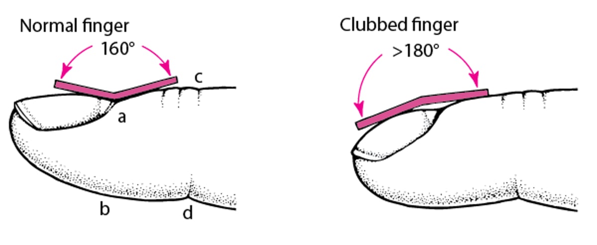 Measuring Finger Clubbing