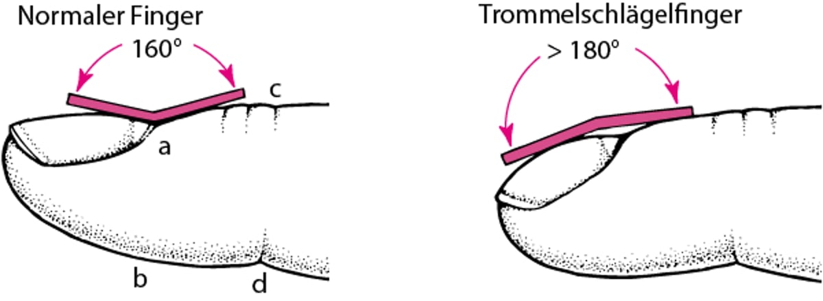 Messung der Trommelschlägelfinger