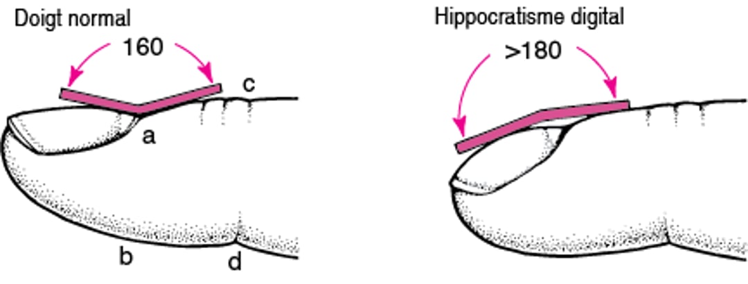 Mesure de l'hippocratisme digital