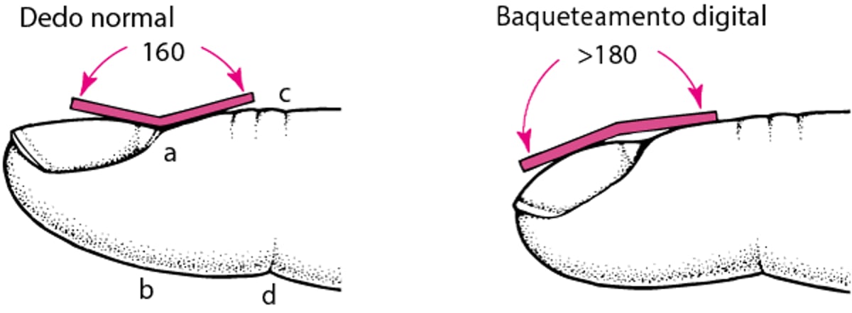 Medição do baqueteamento digital