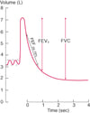 Normal Spirogram