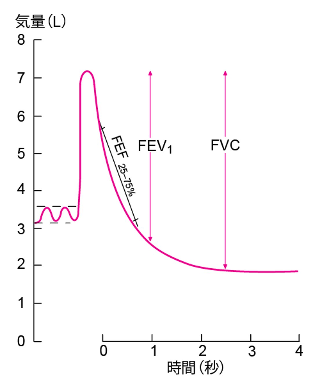 正常のスパイログラム