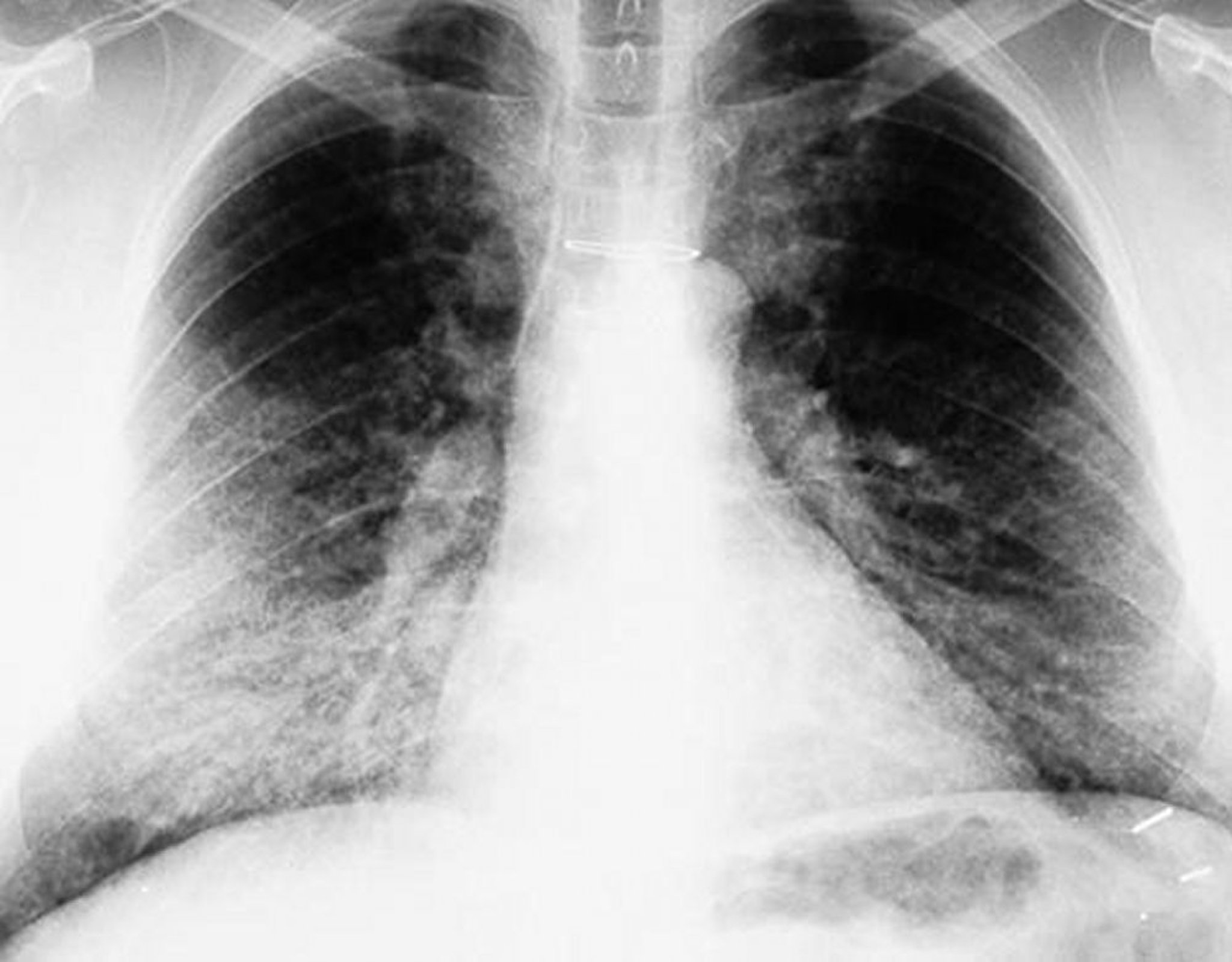 Pulmonary Alveolar Proteinosis (Chest X-ray)
