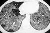 Pulmonary Alveolar Proteinosis (CT Scan)