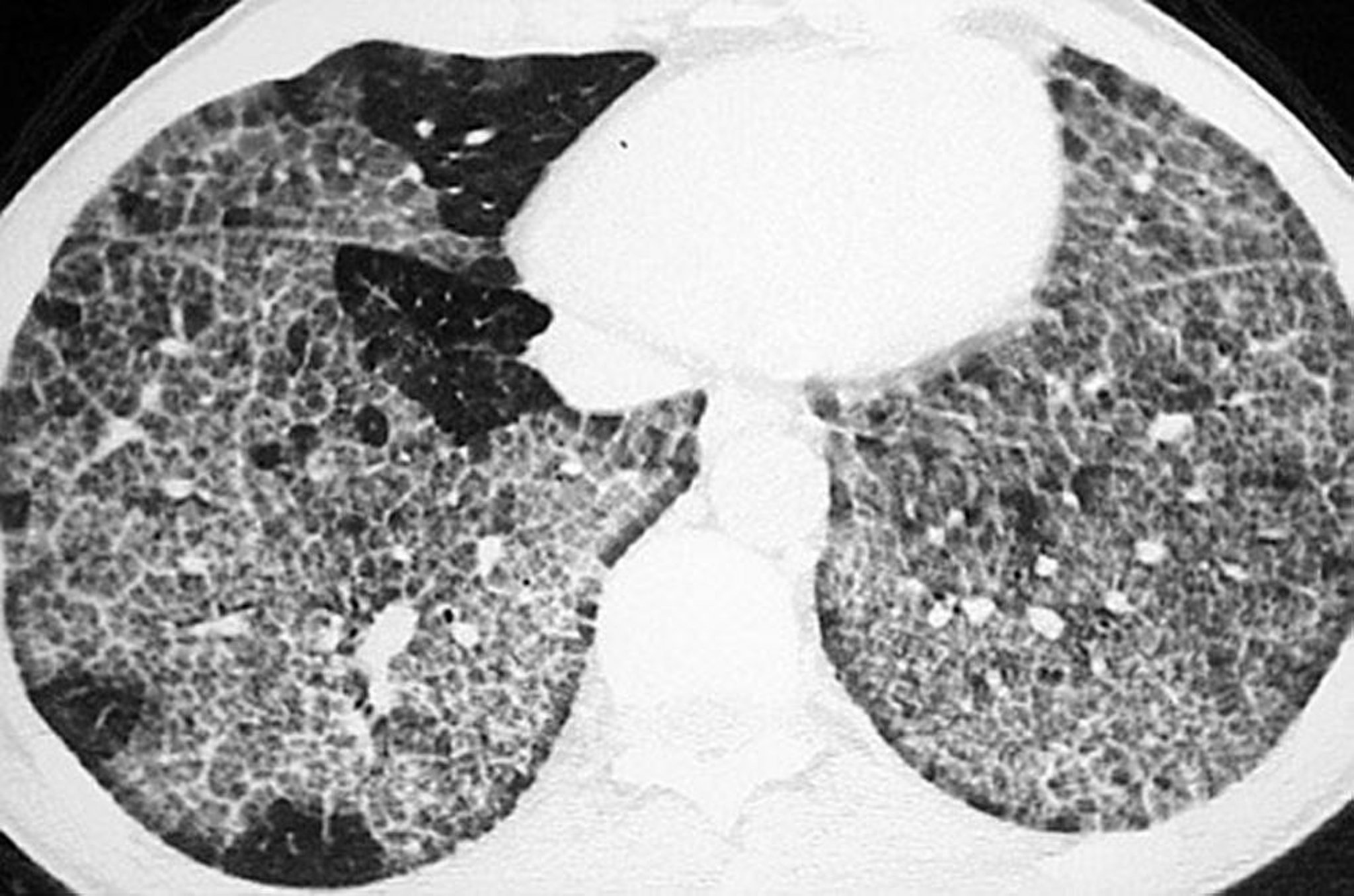 Pulmonary Alveolar Proteinosis (CT Scan)