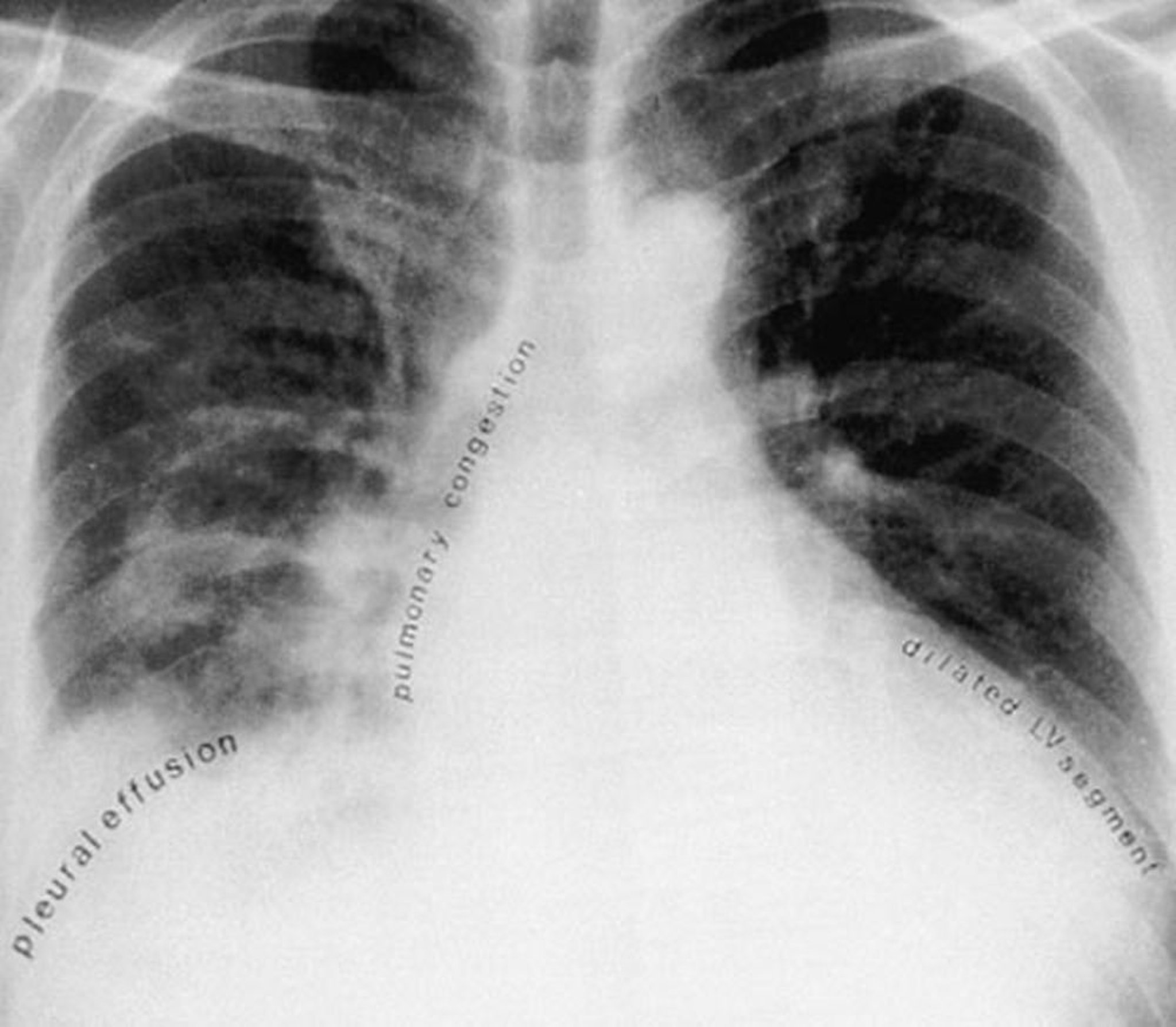 Edema pulmonar