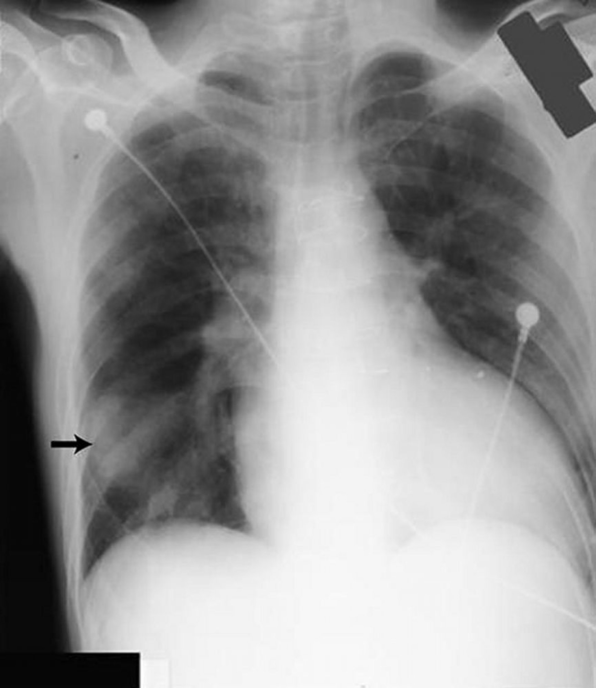 Pseudotumeur pulmonaire