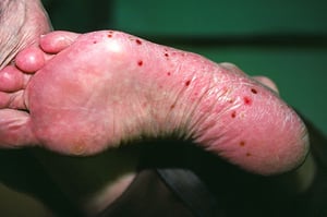 Palmoplantare Pustulose