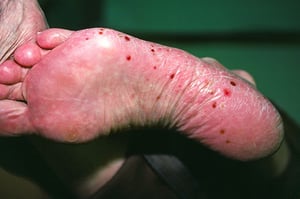 Pustulosis palmoplantar