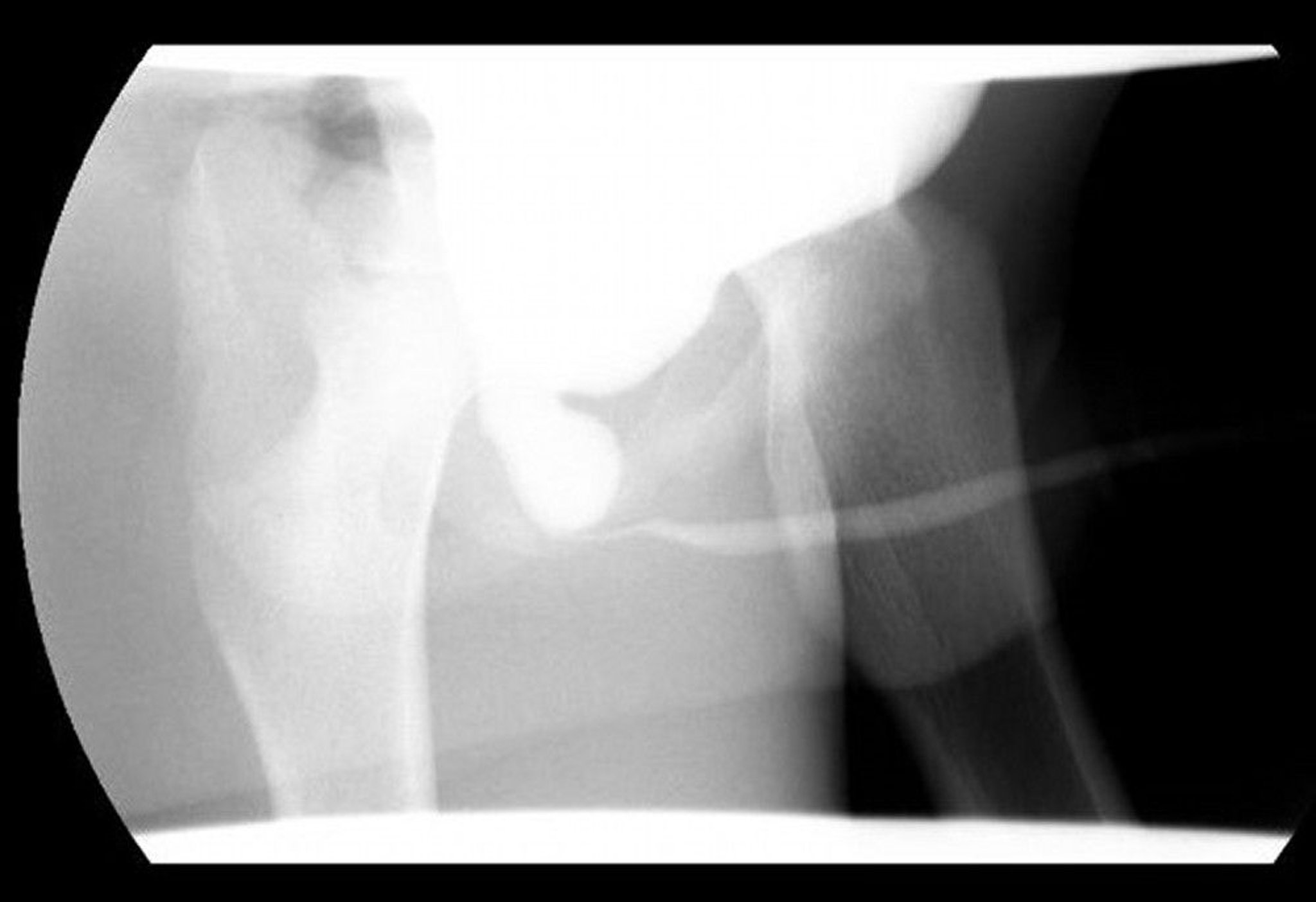 Posterior Urethral Valves