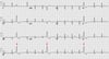 Rythme sinusal avec extrasystoles ventriculaires dû à une ectopie de la voie d'éjection du ventricule droit (infundibulum) (flèches)