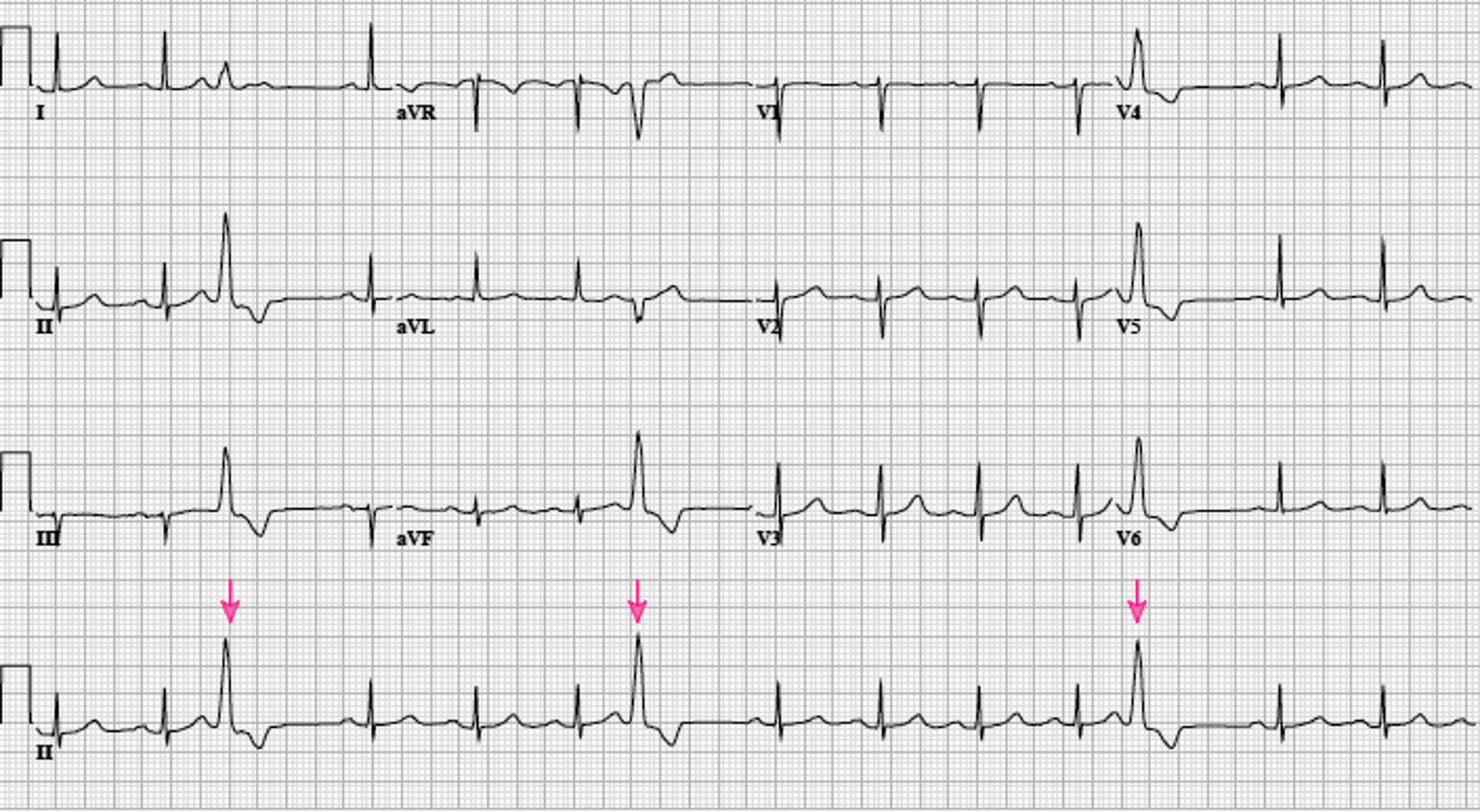 Rythme sinusal avec extrasystoles ventriculaires dû à une ectopie de la voie d'éjection du ventricule droit (infundibulum) (flèches)