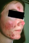 Pyoderma Faciale (Pregnancy-Related)