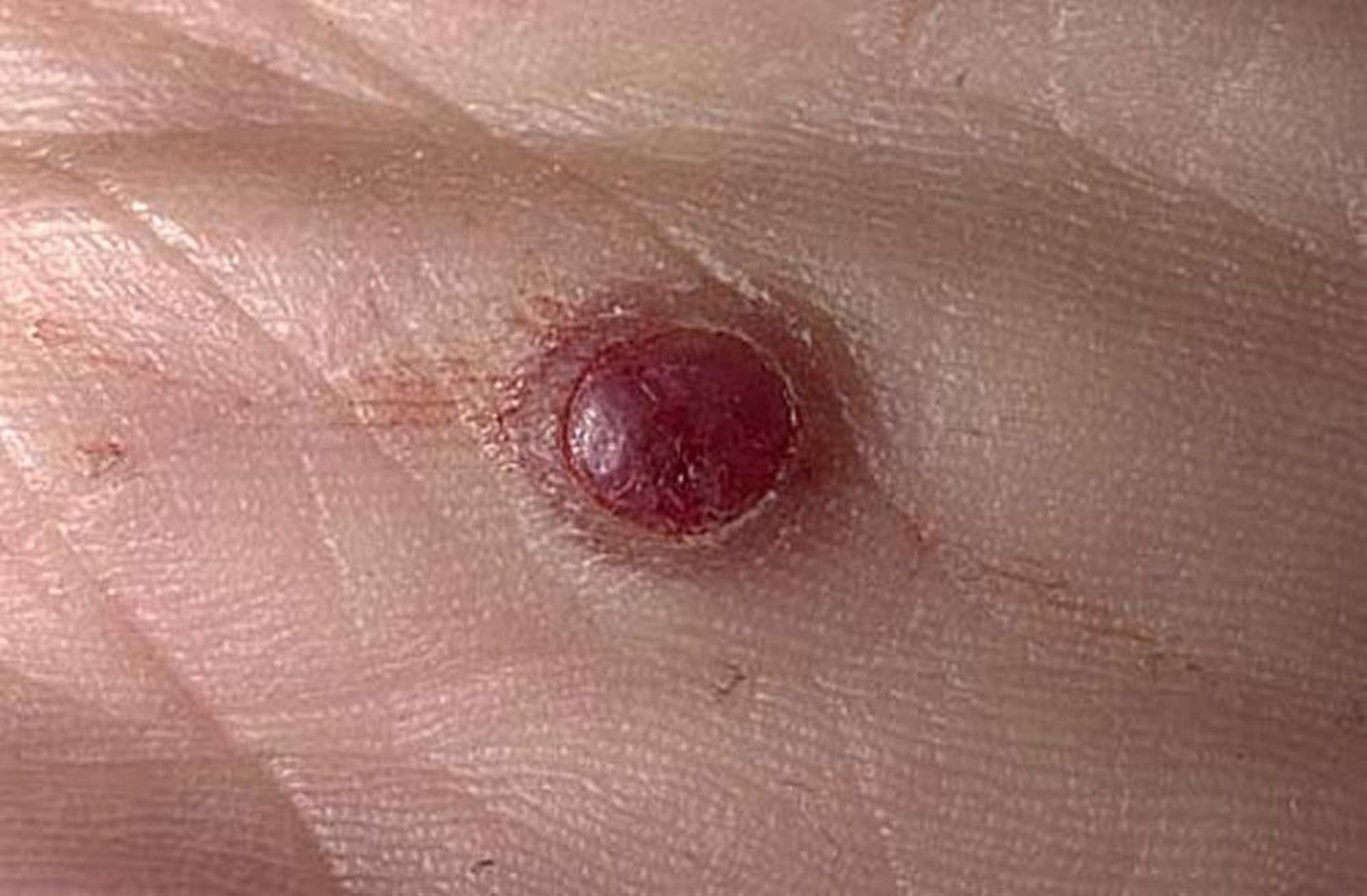 Pyogenic Granuloma (Palm)