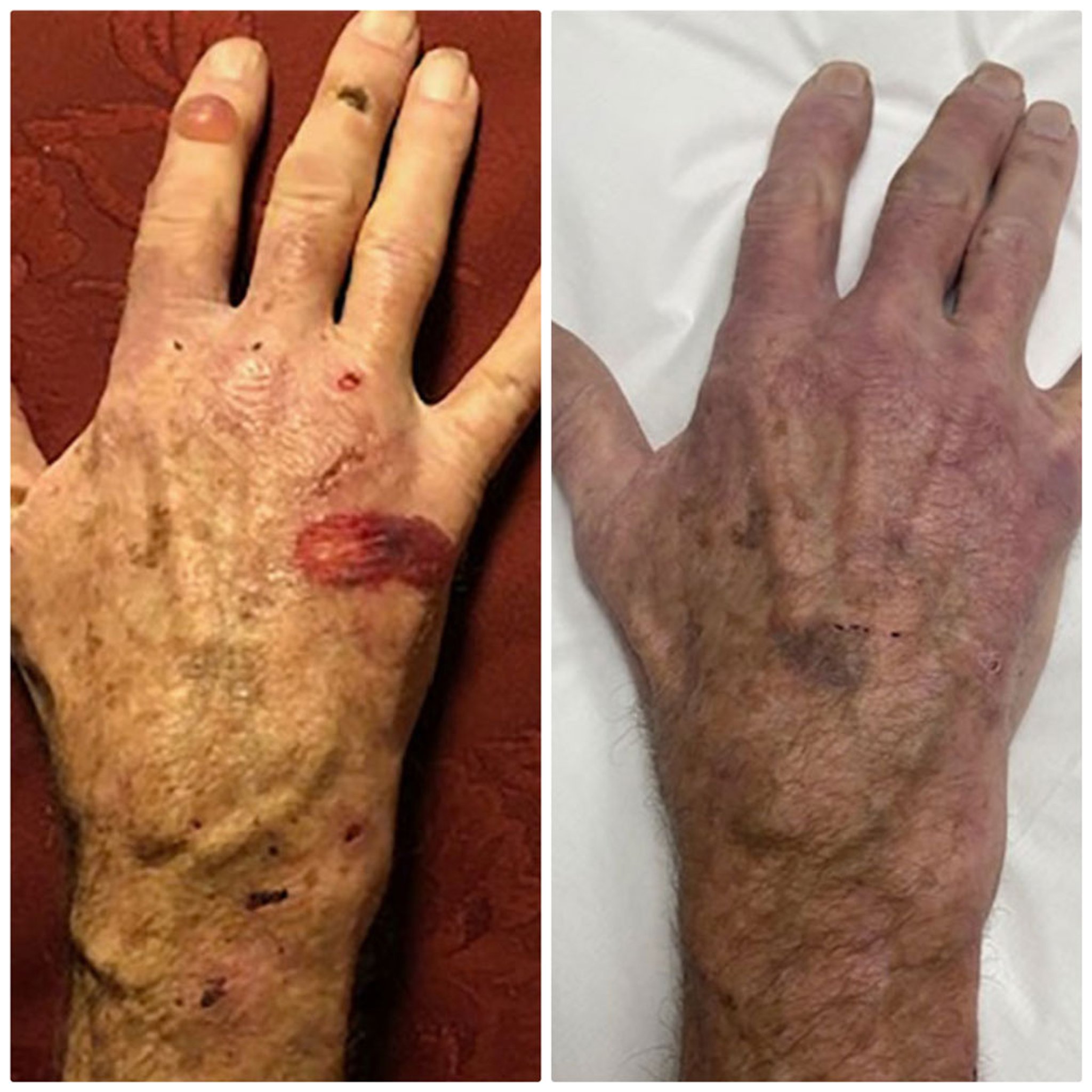 Traitement de réduction du fer dans la porphyrie cutanée tardive de type 2