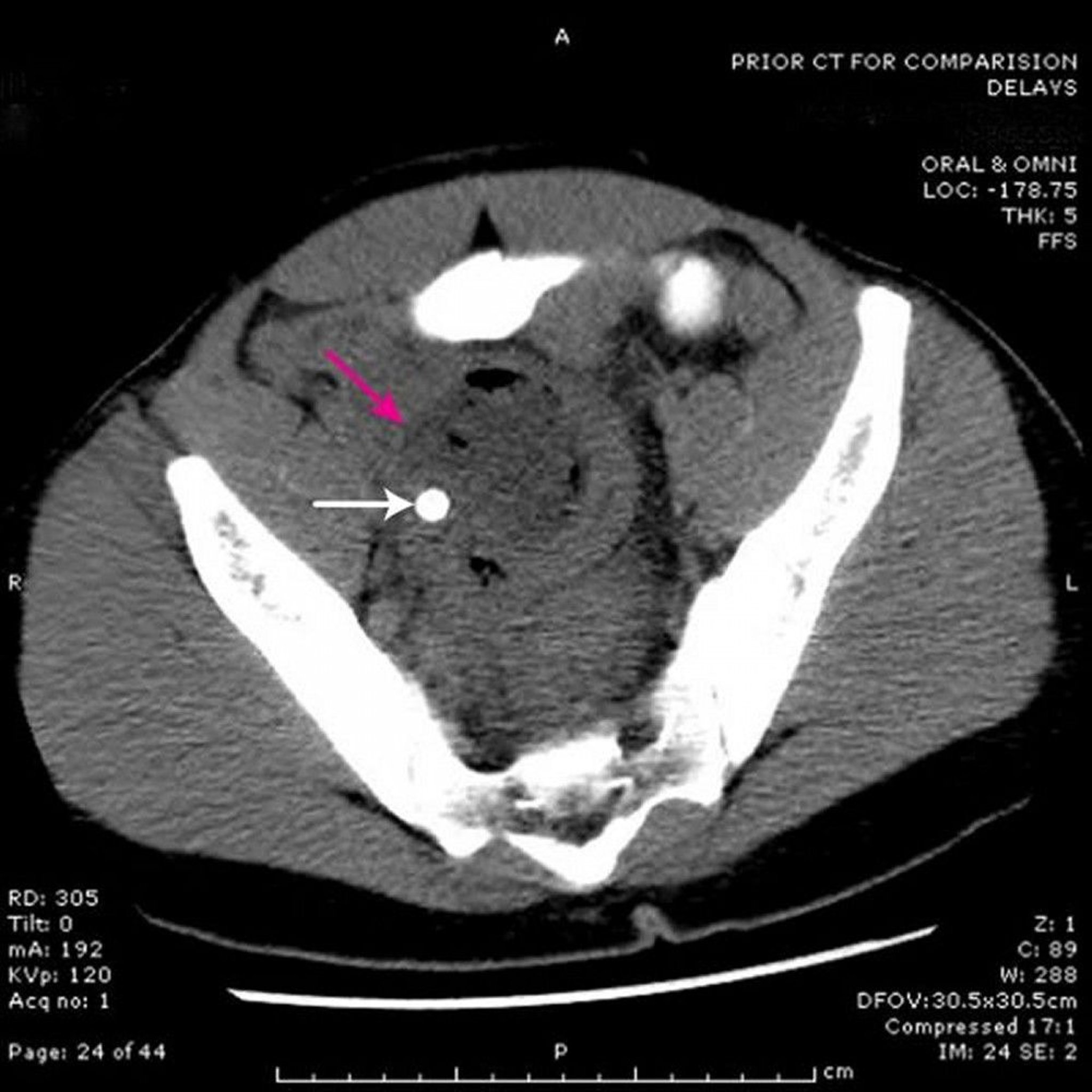 Pelviner Abszess (CT-Scan)
