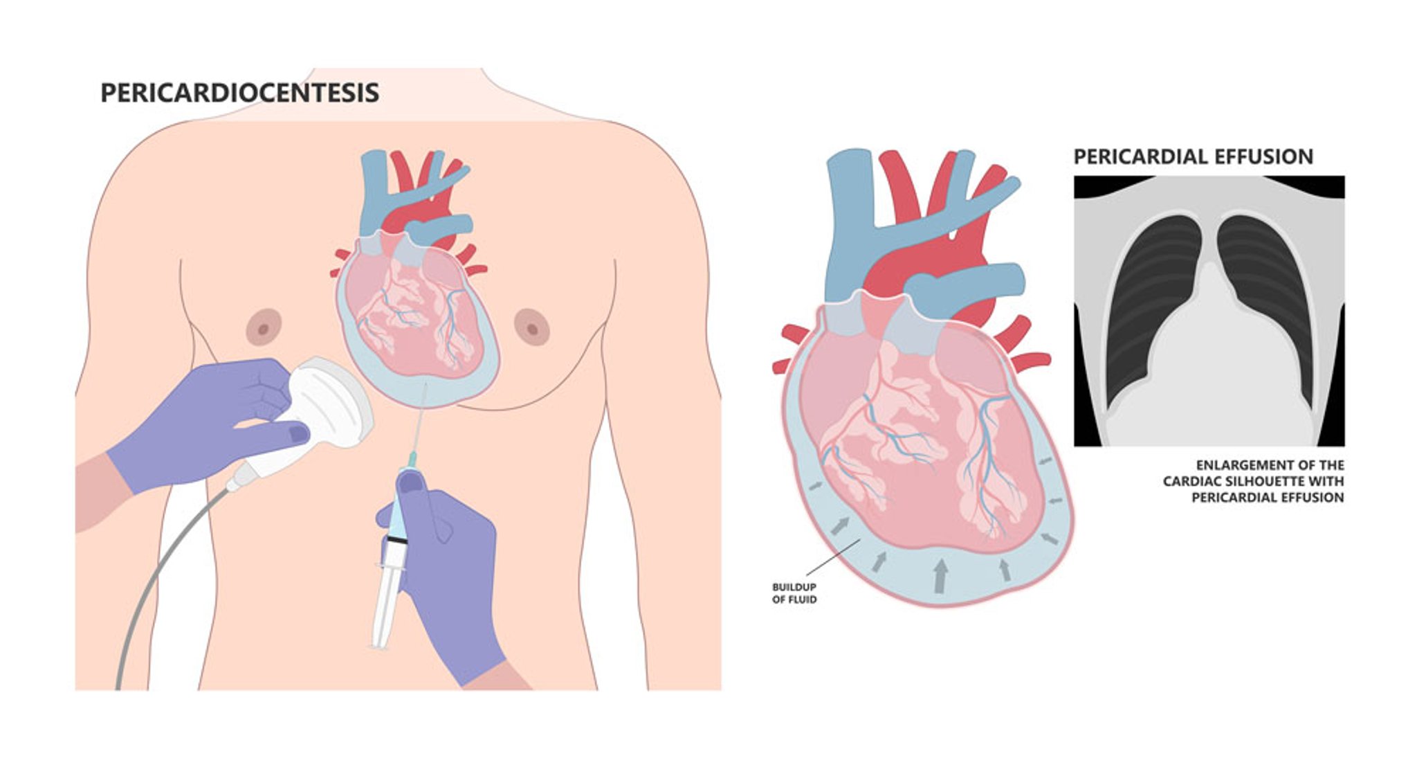 Pericardiocentesis
