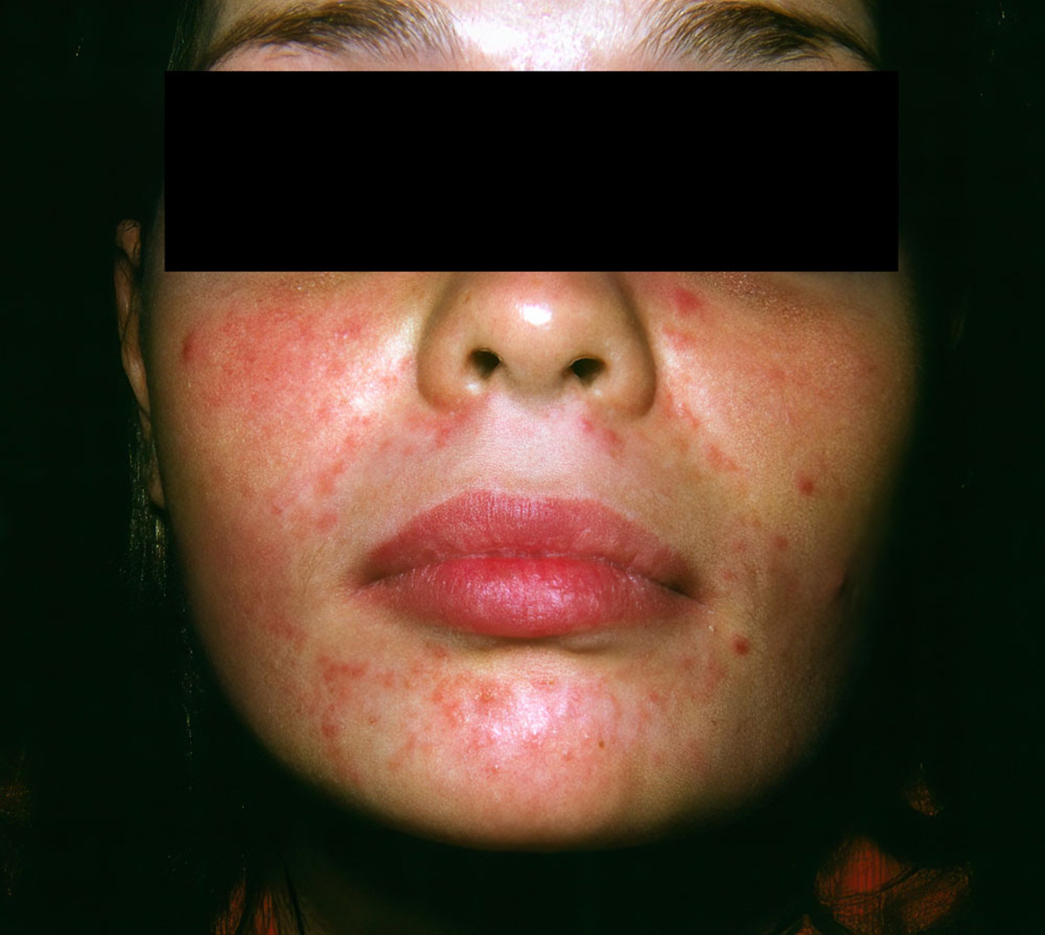 Dermatitis peribucal