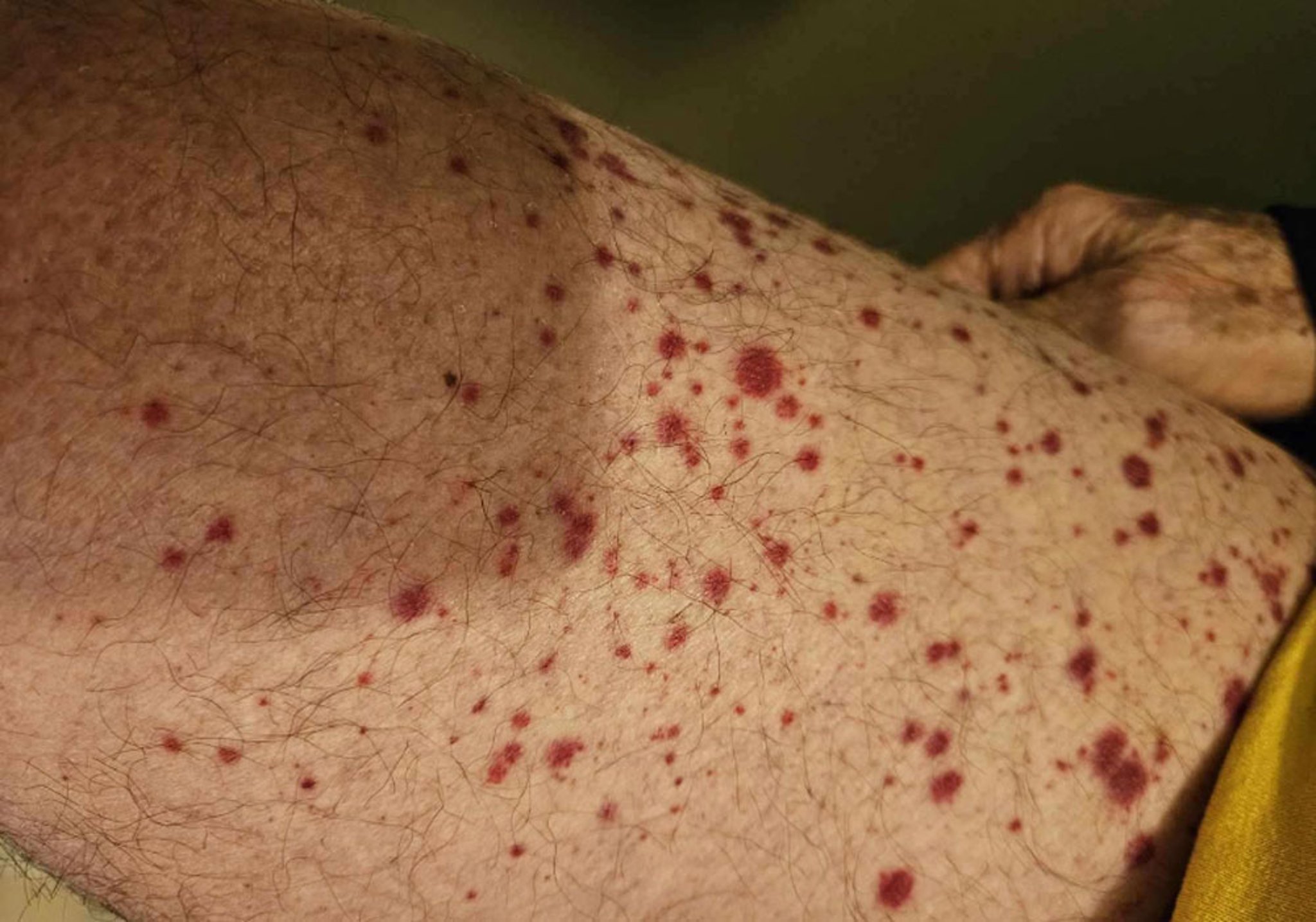 Petechiae in Sjögren Syndrome
