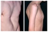 Pectus Excavatum and Pectus Carinatum
